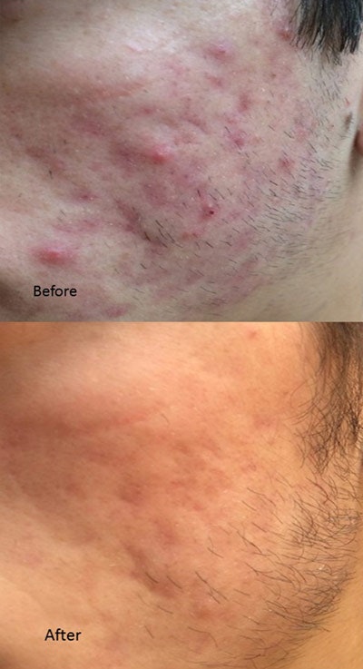 Man+with+acne