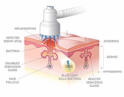 Blue and Red Light from Baby Quasar From Quasar Biotech Inc
