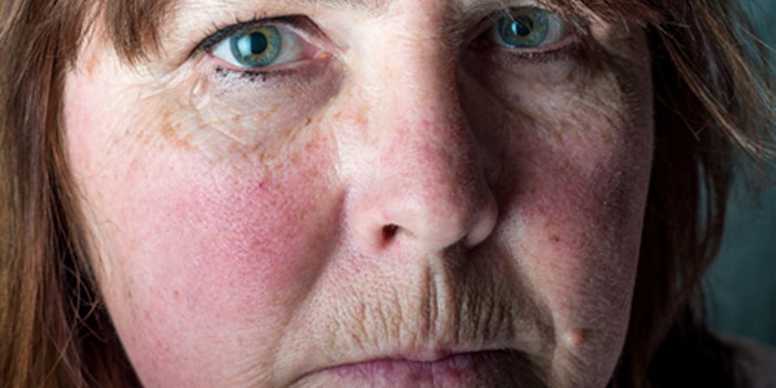 rosacea_nop_i_82015