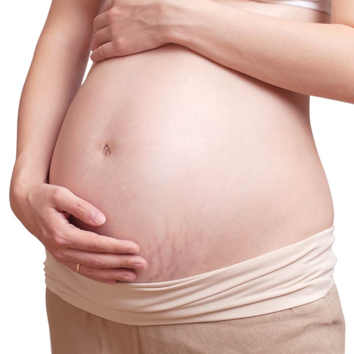 SI1511_StretchMarks_dreamstime_xxl_35084685_850