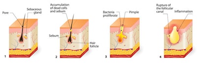 Acne Formation