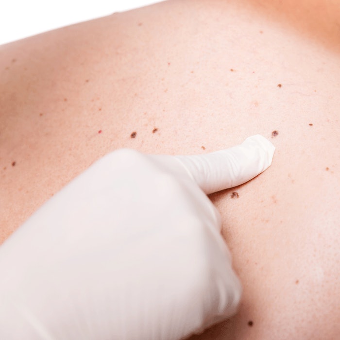 SkinCancerScreening_SI_850