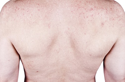 Scars form when an acne breakout penetrates the skin deeply, damaging the tissue beneath. Once the acne breakout clears, the body works to repair the damage, which stimulates collagen production. If too little or too much is produced, a scar will form. If not enough collagen is present, a depressed scar may form. Too much, and a raised scar may result. Knowing the type of scar will aid you in determining the best course of treatment.