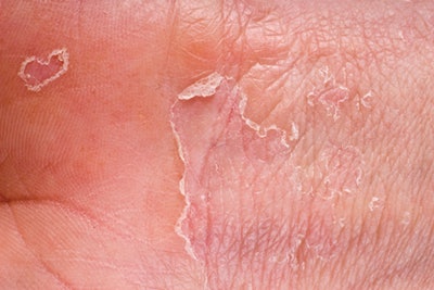 Eczema, or atopic dermatitis, impacts more than 30 million Americans.3 Although many people see this itchy, red rash on their elbows, neck, hands or back of the knees, it is not contained to a specific part of the body. Skin impacted by eczema will be dry and sensitive and the skin to crack can become extremely uncomfortable in some cases.