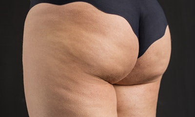 While fat is certainly one component of cellulite, it is only part of the story. Fibrous connective tissue adheres skin to the muscle beneath. As the body ages, this connective tissue contracts and stiffens, causing it to pull down or tighten the skin to push the fat cells out against the skin.
