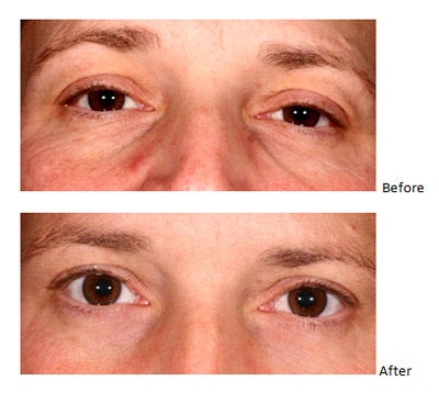 Wrinkles caused be age and sun damage are primarily due to collagen and elastin loss over time. You will notice in the images to the left that the proper collagen/elastin initiators can result in a remarkable improvement.