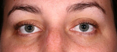 In general, the use of topicals will be sufficient in managing the