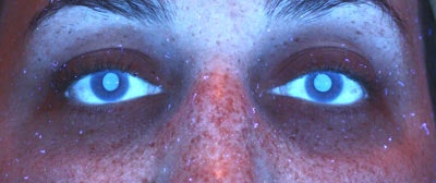 tonal change that is seen. The use of hydroquinone is generally avoided due to the irritation potential involved.There are products available that contain a variety of gentle lighters such as undecylenoyl pheylalanine, botanical lighteners, kojic acid, etc. You can see the “shadow” produced by the banding pattern in the images to the left, with the right image under color UV clinical photography.