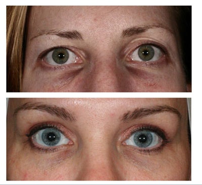 Tip #3. Melanin banding patterns tend to darken with age, so the earlier they can be identified the better the lightening result will be. Hemoglobin deposition (under eye darkness) occurs when blood passes through the fine capillaries in the under eye area and tends to accumulate in that area. The coloration in the under eye area can range from a dark rust color to a lighter pink color depending on the severity and age of the condition. The application of a topical can usually manage this condition, but it must contain an ingredient that can “chelate” and therefore remove the hemoglobin. See the pictures on the left for the types of hemoglobin.