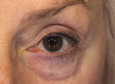 Under eye puffiness is usually caused by one of two issues. Either the under eye area accumulates water in the tissue or fat pads in the face tend to atrophy over time and change in size and location in the face. If the fat pads in the face are the root cause as shown in the image to the left, there is little that can be done other than surgery. If the challenge is water