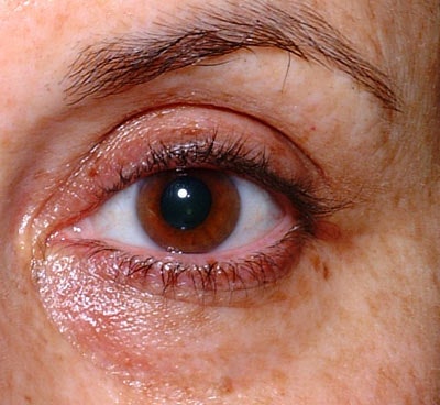 accumulation (as shown in the image to the left), using the effleurage technique as described above is effective. The image to the right is an example of under eye puffiness from fat atrophy.