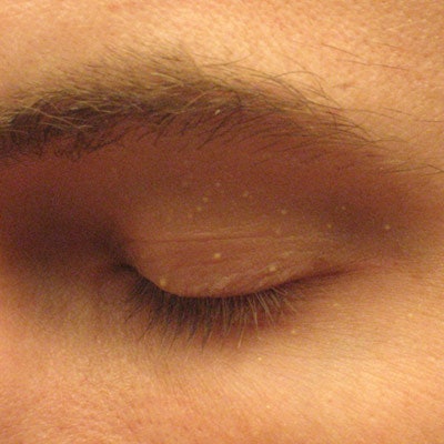 Don t Just Stick a Needle In It Eye Lesions Skin Inc