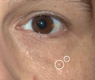 Cause. Syringomas stem from eccrine glands, small sweat glands present on the entire body that protect the body from heat. At the top of eccrine glands are ducts or openings, where sweat is released. When the eccrine ducts are enlarged beneath the superficial layers of skin, they can create small, 1-3 mm, visible and raised skin lesions. Syringomas differ from milia in their color and uneven border; their shape may look like small tear drops.