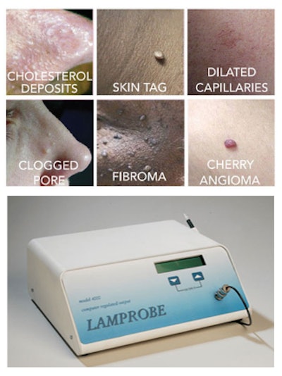 Seborrheic Keratosis