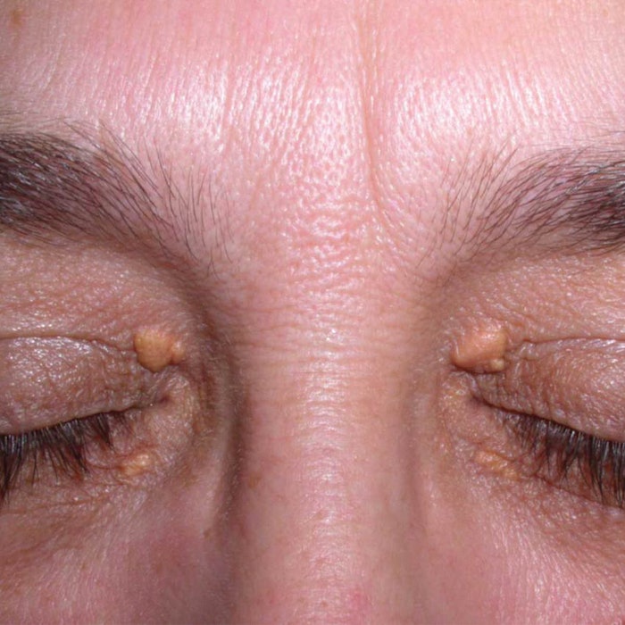SI1604_Wojak_Xanthelasma_850