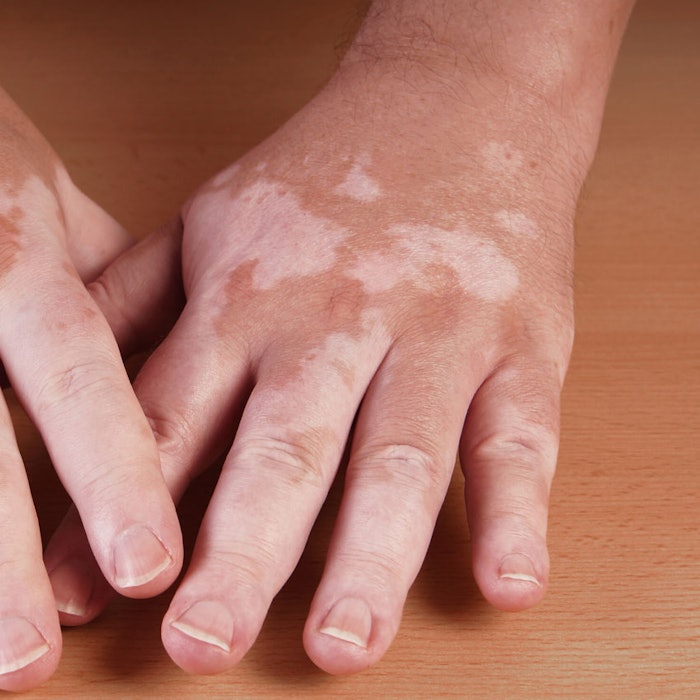SI_vitiligo_bb