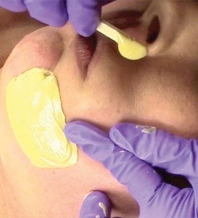 Proper technique. To prevent damage to the skin and its underlying structures, it is important to use proper technique. The skin should be held taut on both application and removal of the wax. If skin is not held taut during application, it will not “shrink wrap” properly to remove the hair cleanly, which can lead to repeated application over the same area and an increased chance of damaging the skin. Additionally, when the skin is not held taut on application, it creates a pull and drag under the stick as the wax is applied, which might cause the skin to become more lax in the long run.