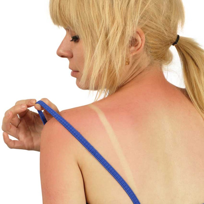 sunburn_bil