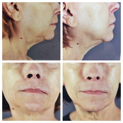 I decided to try this procedure for two reasons. First, I am a baby boomer who prefers non-invasive methods to fight aging. Second, as an industry insider, I wanted to see what I could learn and share with my peers. The more we know, the better we can assist our clients.