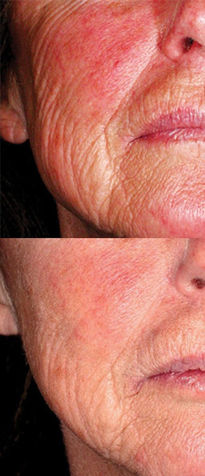 Bacteriostatic compounds should be used daily. They will slowly reduce the population of skin bacteria and, in many cases, skin redness over time (7-10 days). The best way to apply a bacteriostatic agent is to use a cleanser containing it. Since bacteriostatic compounds are typically oily in nature, the skin will attract them nicely from the cleanser formula. Bacteriostatic Treatment shows the effectiveness of this approach before and after a two-week treatment.