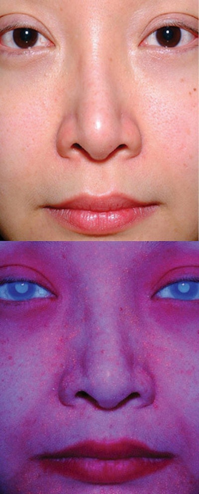 Barrier Function Impairment