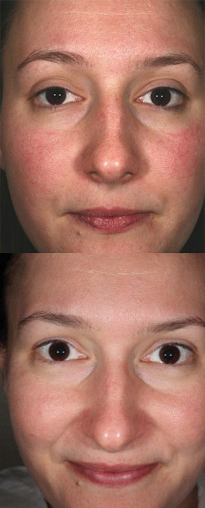 In this case, you can be sure your clients have well-hydrated skin by using lotions and creams that have both barrier function improvement ingredients and sebum-replacement ingredients in them. As an example, caprylic/capric triglyceride is one commonly used sebum replacement ingredient that can provide relief, and it is available in synthetic or natural forms. Barrier Treatment shows skin redness before and after barrier function impairment and normalization, respectively.