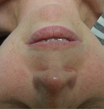 Estheticians do not want a reactive skin type to suffer even the slightest bit, so look for ingredients that the reactive skin can manage and even utilize to boost the immune system to reduce their reactivity. Oftentimes, environmental aggressors can cause this.