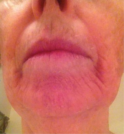 Some clients are healthy but have sensitized their skin due to overuse of glycolic, facial devices or brushes, topical bleaches, like hydroquinone, retinoids, etc. This is commonly called cosmetic intolerance syndrome (CIS), which has compromised their barrier function.