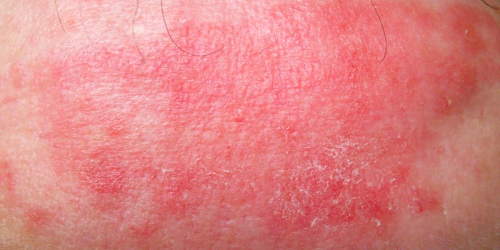 Eczema_425