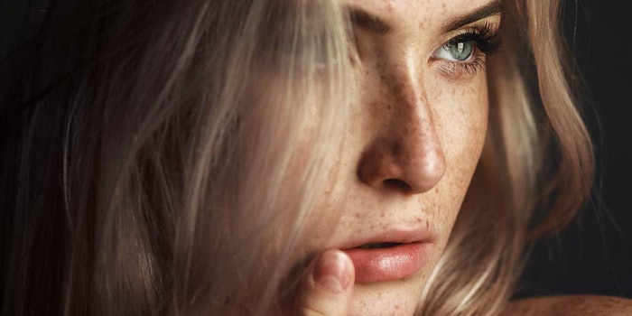 SI1701_Pigmentation_dream_78490566_freckles_800_np