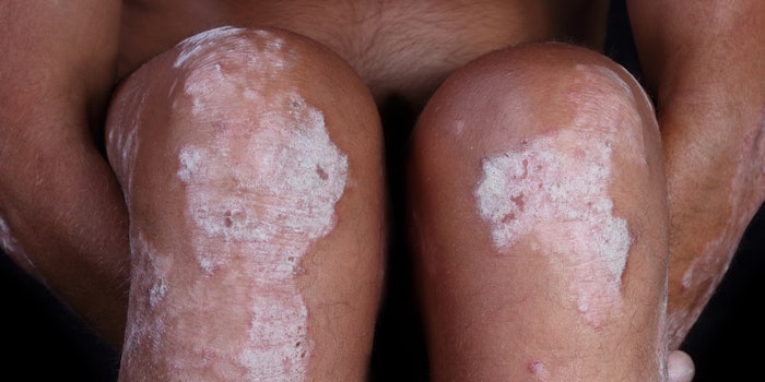 si_psoriasis_lead_22317