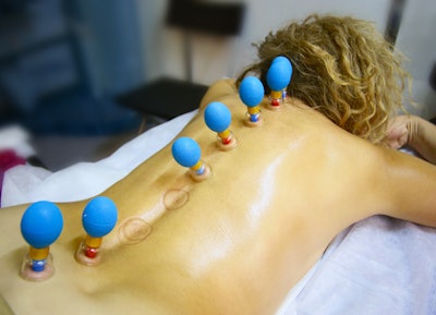 cupping-therapy