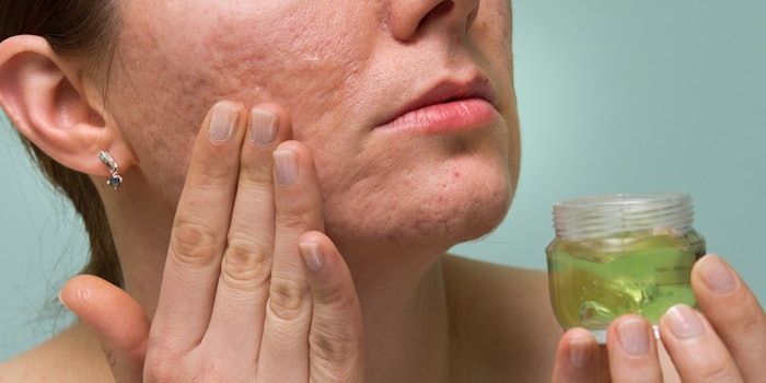 si_acne_lead_31017