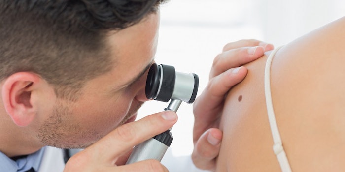 si_melanoma_lead_42717