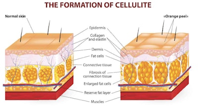 cellulite