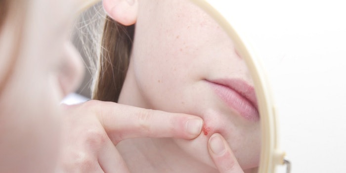 si_pimple_lead_61317