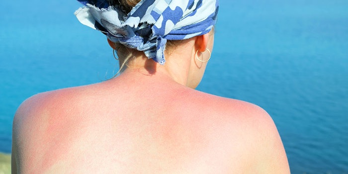 Si_SunburnVitD_425