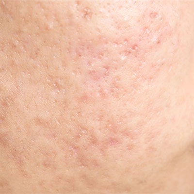 Atrophic Scar