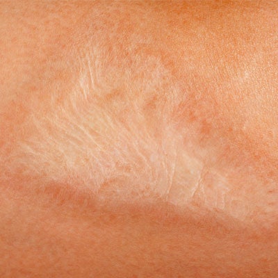 Contracture Scar