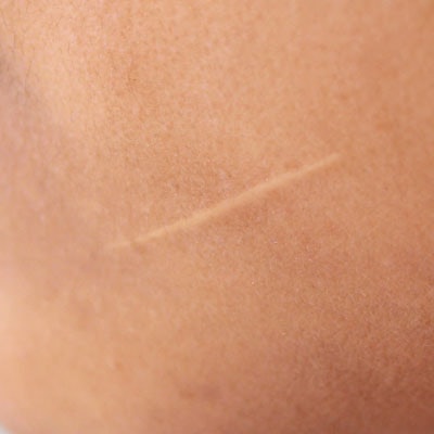 Flat Scar