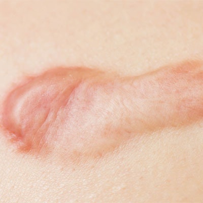Hypertrophic Scar