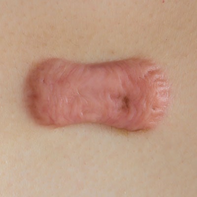 Keloid Scar