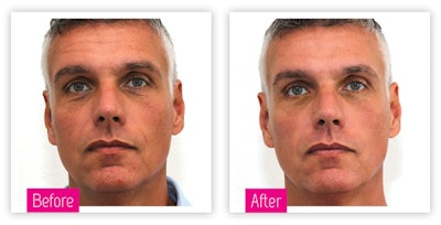 Dermatude Si1708 Beforeafter31