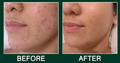 DMK - Acne Before and After