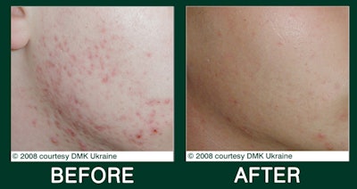 DMK Before and After Acne Treatment