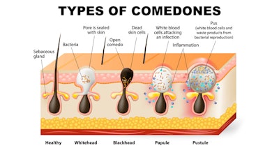 Types Of Comedones
