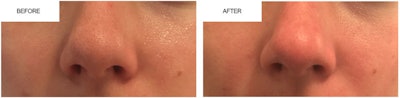 Dermamed Before/After