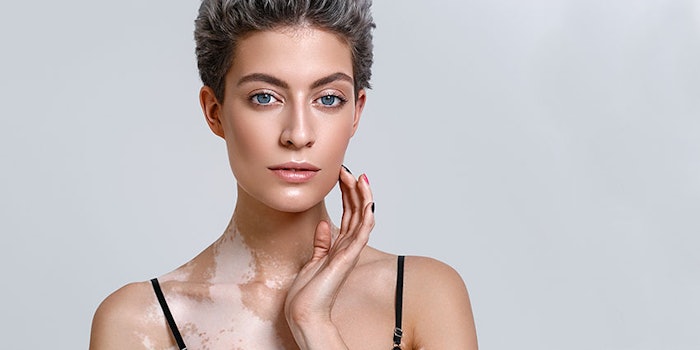 SI_Vitiligo_425