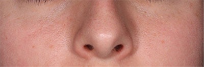 Case Study: Closeup of Cheeks/Nose After