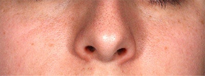 Case Study: Closeup of Cheeks/Nose Before